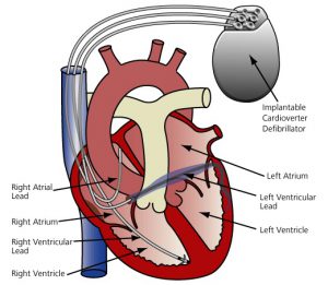 What is an ICD? – Cry